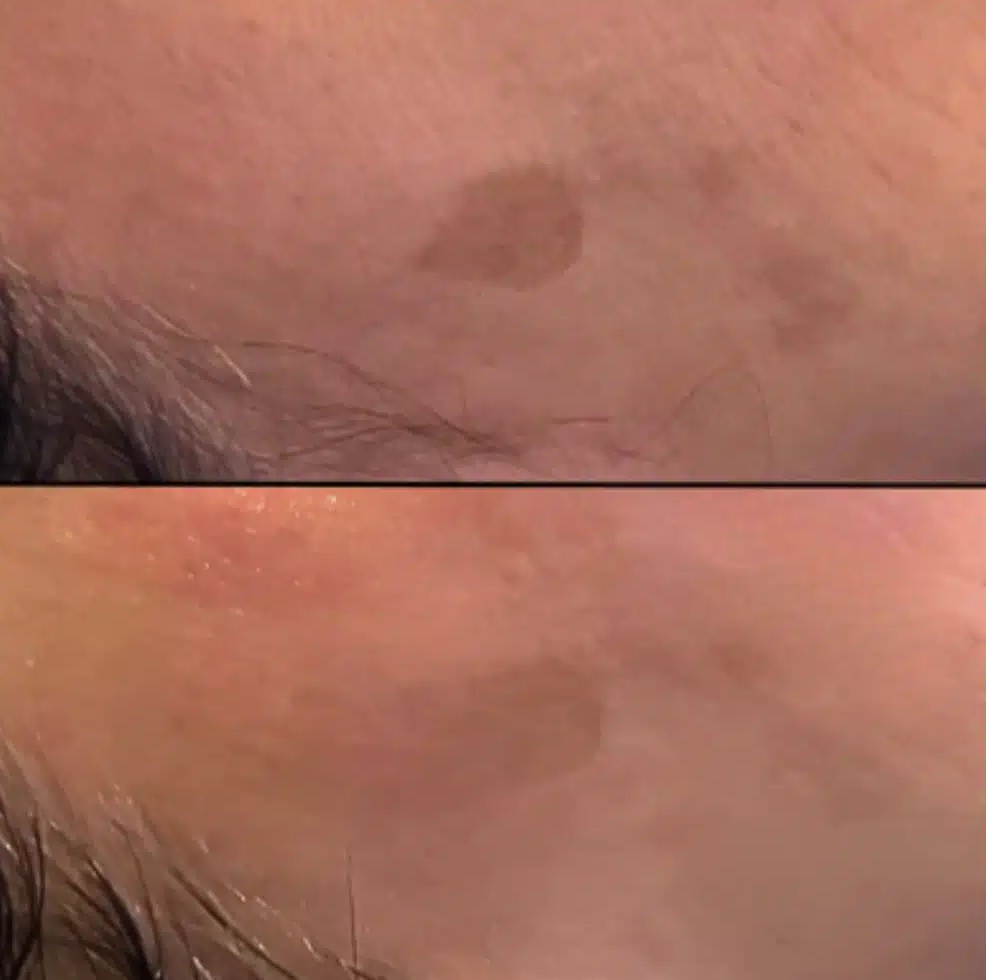 Algenpeeling-behandeling tegen pigmentvlekken